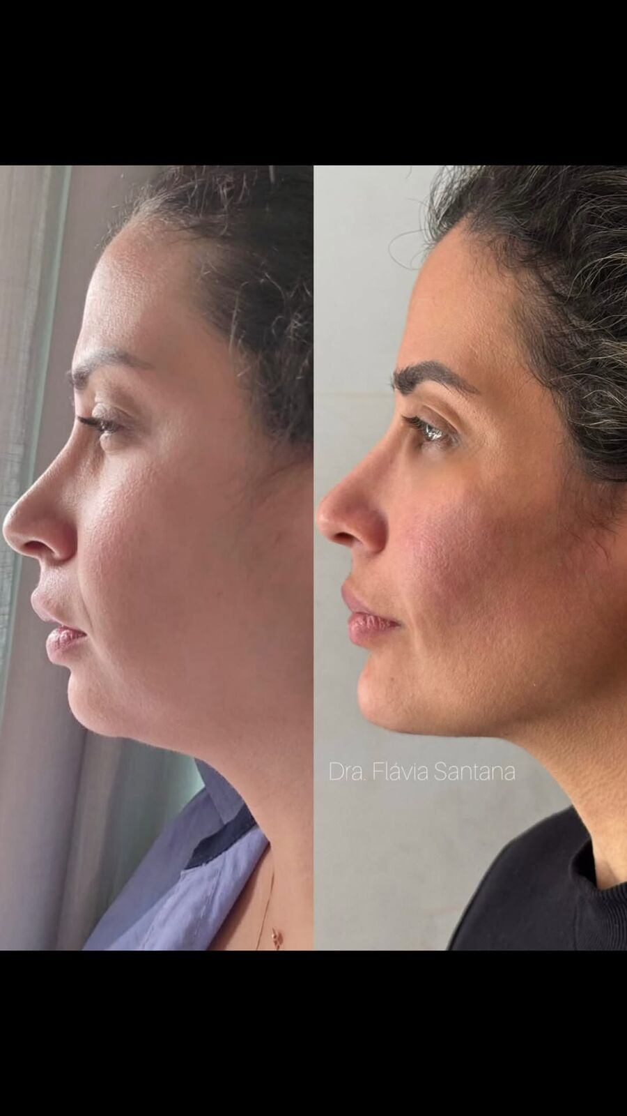 Antes e depois de estruturação facial completa pelo Método Imperium