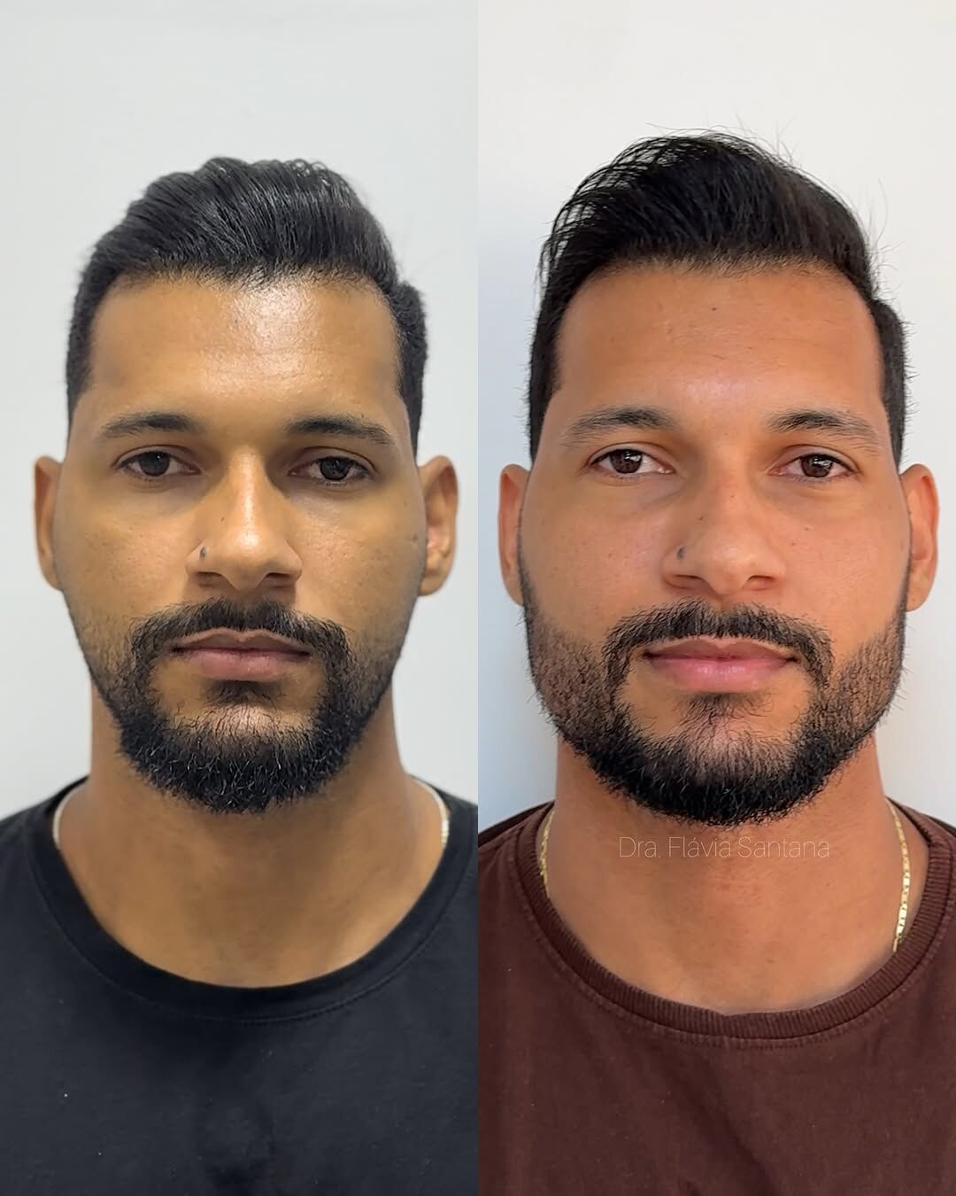 Antes e depois de harmonização facial masculina