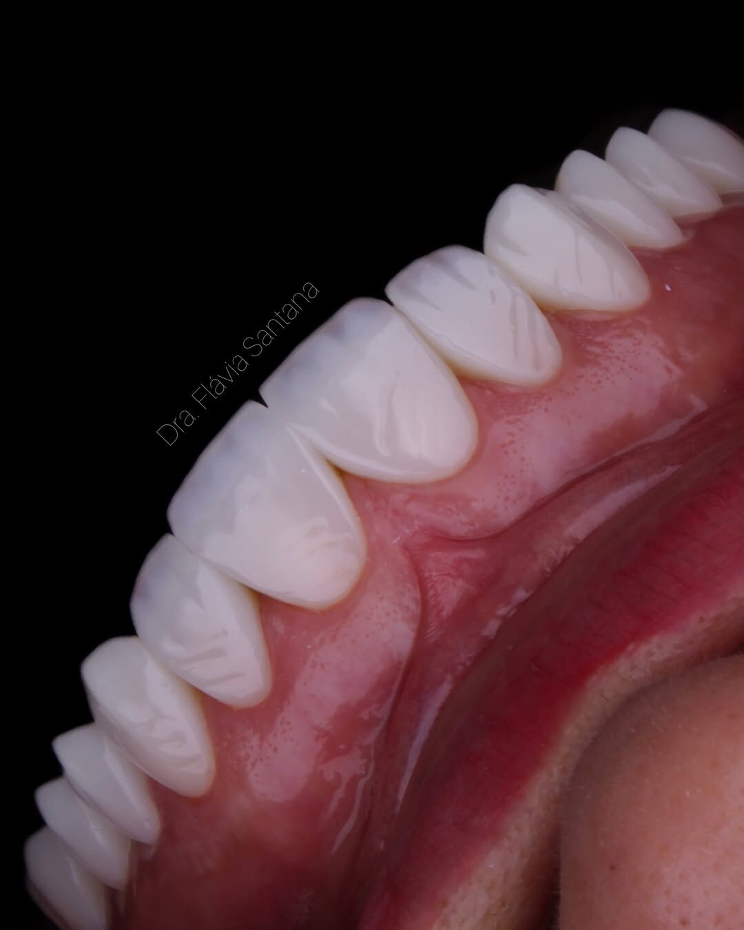 Detalhe de lentes de contato dental com aparência natural