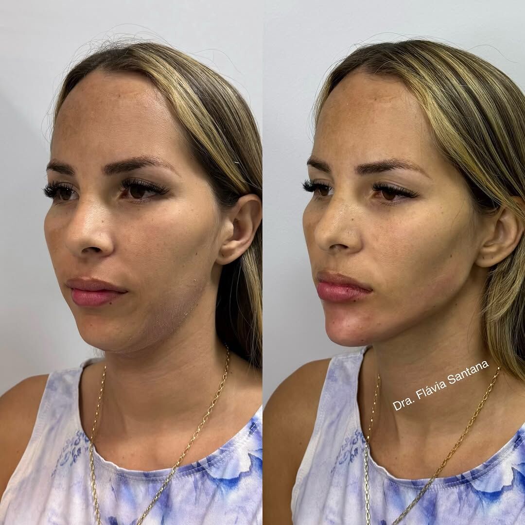 Antes e depois de preenchimento e contorno facial