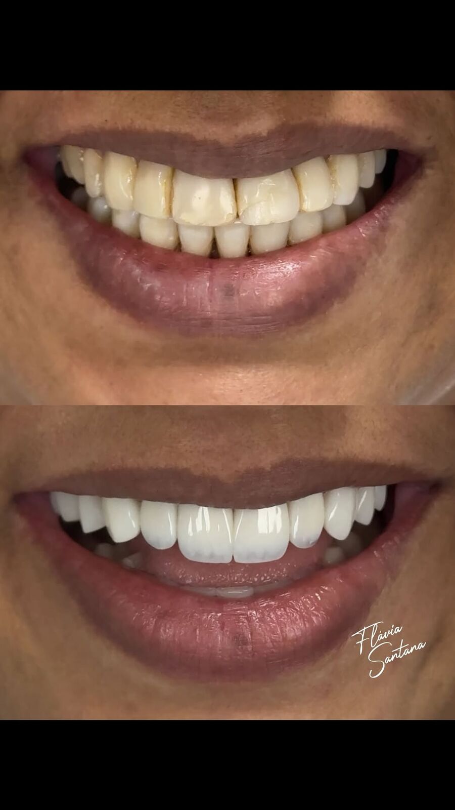 Antes e depois de sorriso com lentes de contato dental