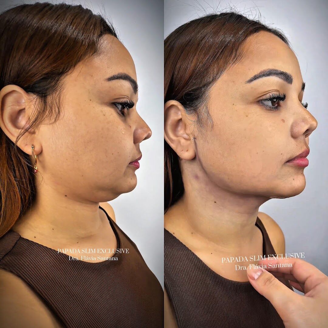 Antes e depois de definição de mandíbula e papada