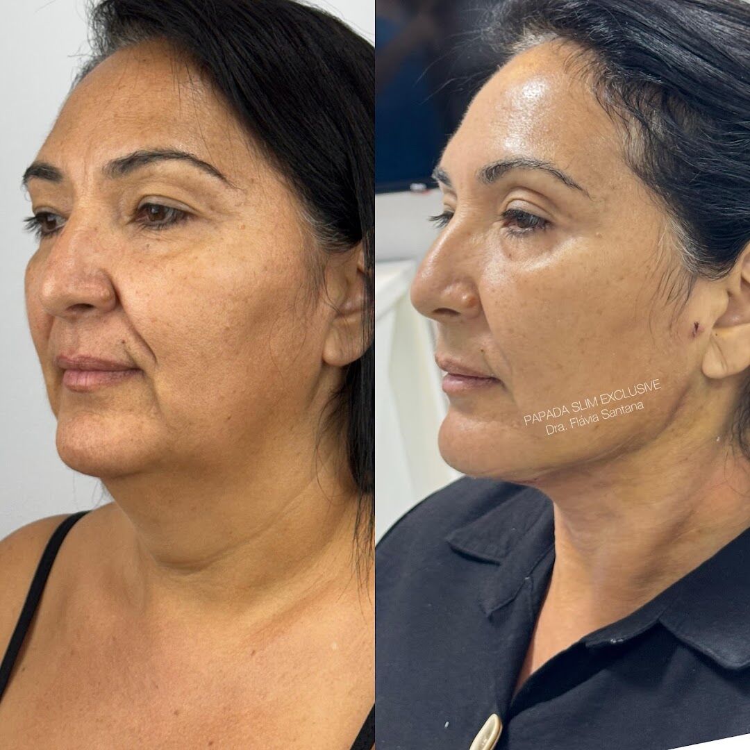 Antes e depois de harmonização e rejuvenescimento facial