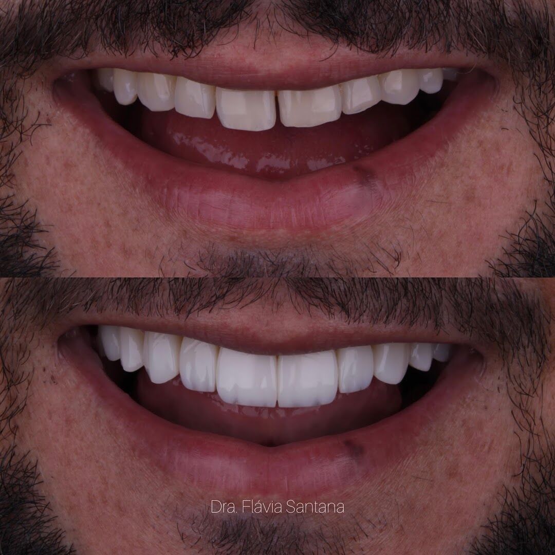 Antes e depois de reabilitação do sorriso